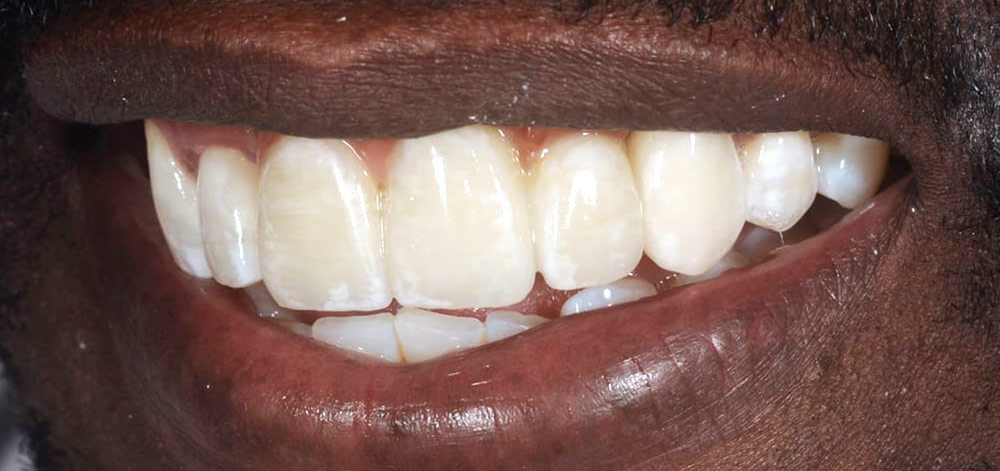 afterbefore treatment