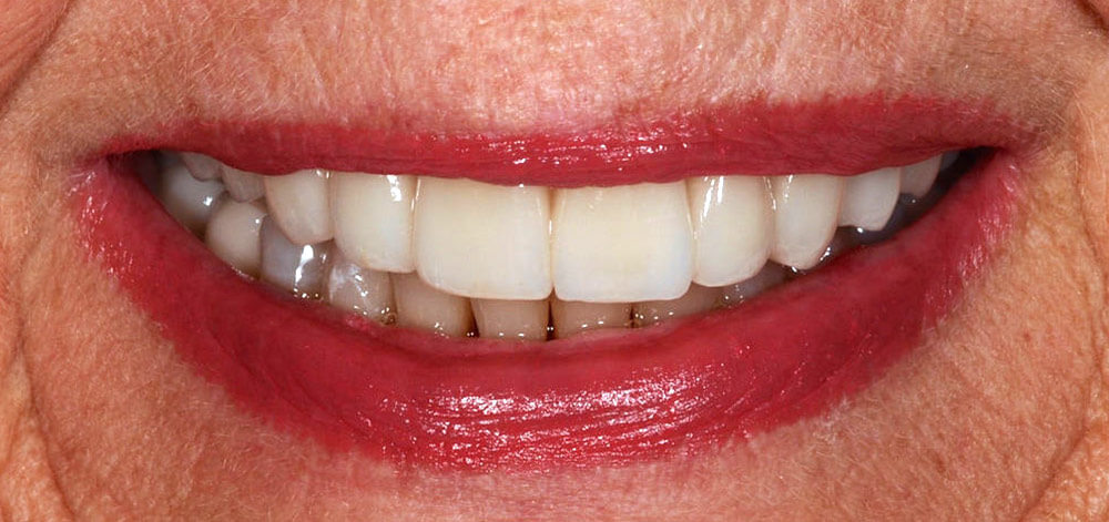 afterbefore treatment