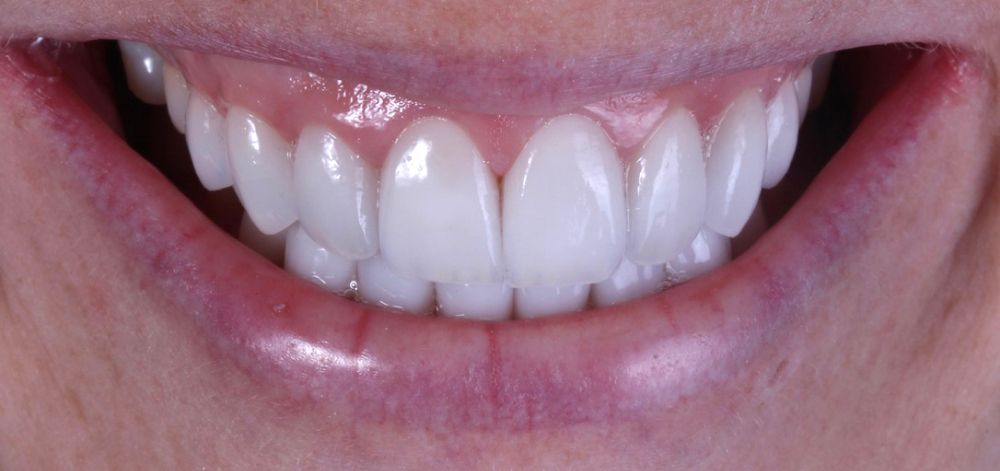 afterbefore treatment