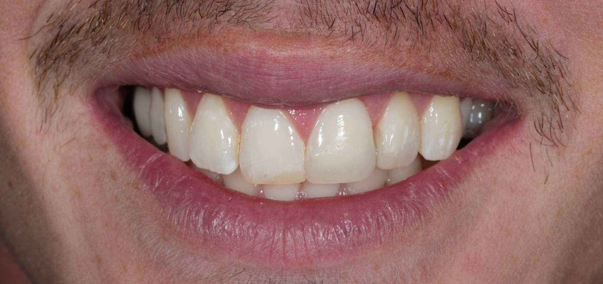 afterbefore treatment