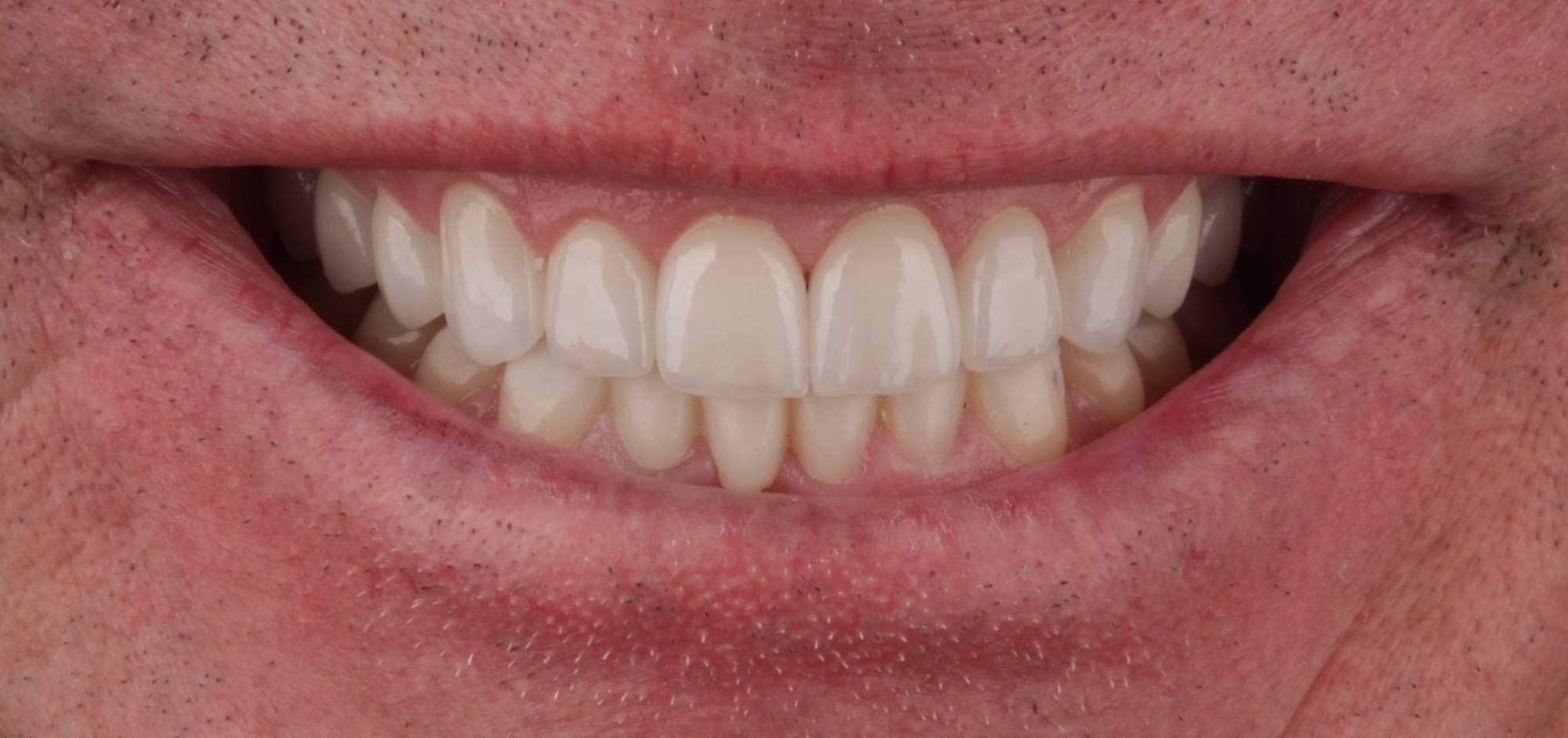 afterbefore treatment